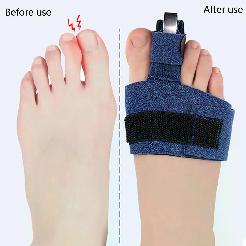 1Pcs Toe Corrector Toe Fractur - Ankle Brace Sock incelemesi ve fiyatı